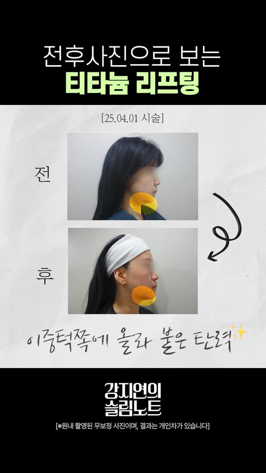 钛提升——术前术后对比