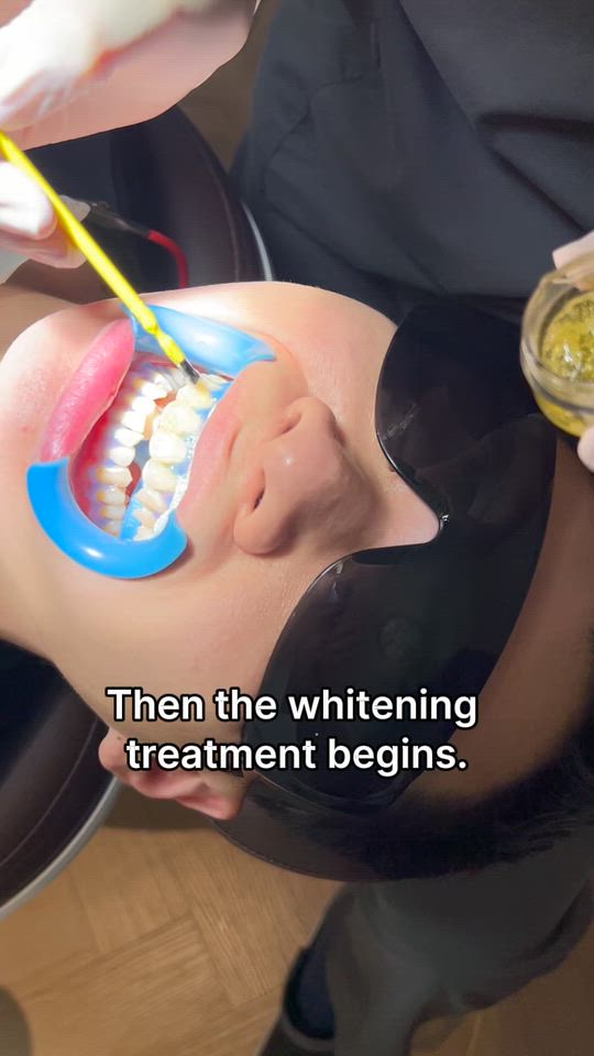 Brighten Your Smile in 60 Minutes │ Dogo Dental Clinic Scaling + Whitening Package (iipuda Exclusive)