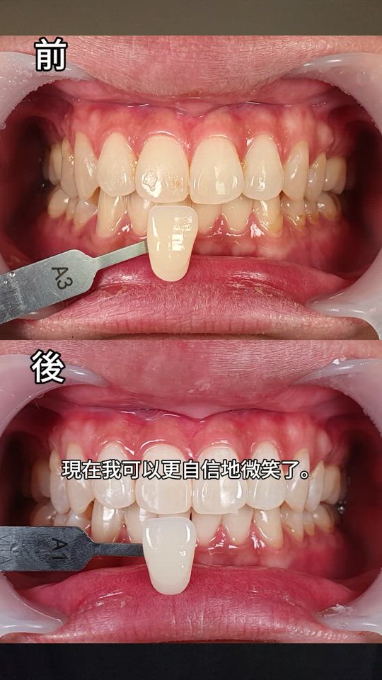 60 分鐘亮白升級 │ Dogo 牙科 洗牙＋美白套餐（iipuda Exclusive）