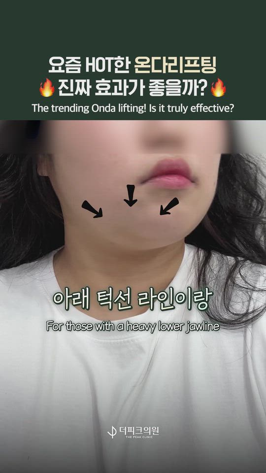 The answer to double chin fat is Onda lifting